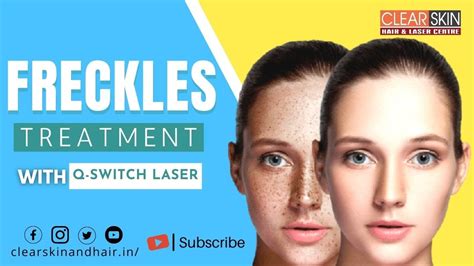 Freckles Treatment By Q Switch Laser Best Freckles Laser Treatment Clear Skin Hair And Laser