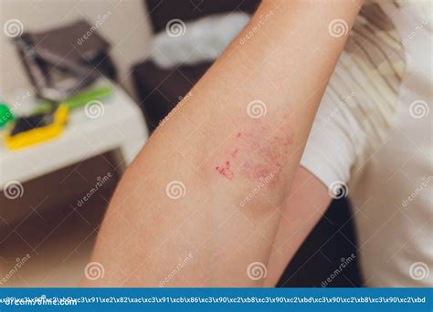 Abrasion On The Underarm Which Occured In Outdoor Sports Stock Image