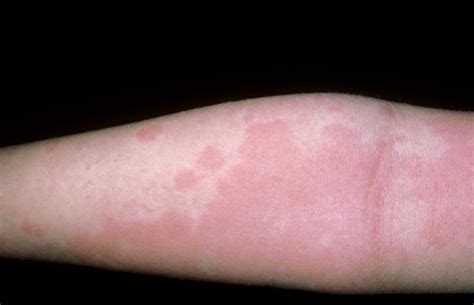 The term €rash€ refers to red eruptions forming on the skin. What 9 Common Skin Rashes Look Like