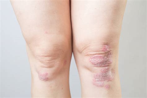 Psoriatic Arthritis Stock Photos Pictures And Royalty Free Images Istock