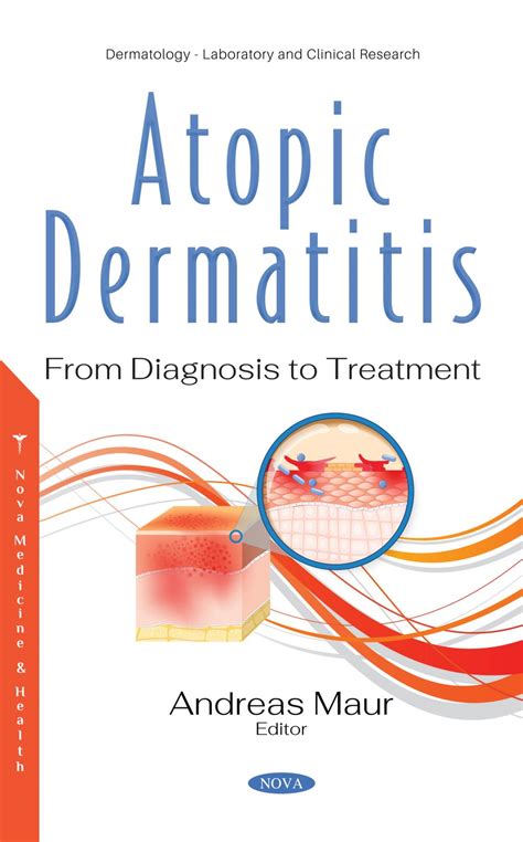 Atopic Dermatitis From Diagnosis To Treatment Nova Science Publishers