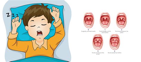 Obstructive Sleep Apnea In Pediatric Patients Sprig Oral Health