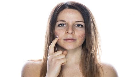 Does Masturbation Cause Acne Yes It Can But Only If You Overdo It By Doctor360 Medium