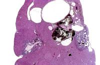 Hepatoblastomas The Digitized Atlas Of Mouse Liver Lesions