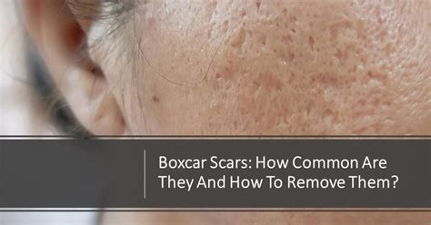 Boxcar Scars How Common Are They And How To Remove Them Dream