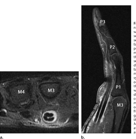 Figure 1 From Soft Tissue Infections And Their Imaging Mimics From