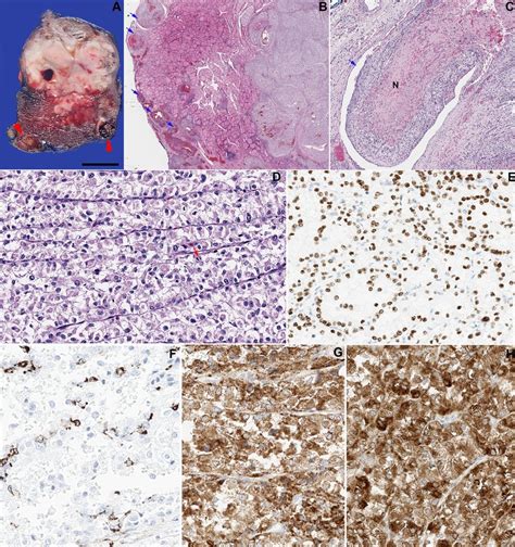 A Primary Malignant Perivascular Epithelioid Cell Tumor Of The Thyroid