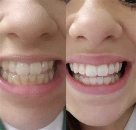 Teeth Whitening Bournemouth Ringwood Cosmetic Tooth Whitening Dorset