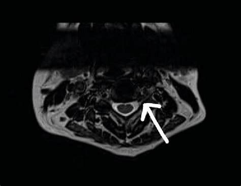 Single T2w Axial Mri Image Of Cervical Spine Showing Left Paracentral
