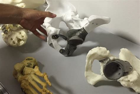 Italian Hospital Begins Using 3d Printed Prosthetic Bone Implants On
