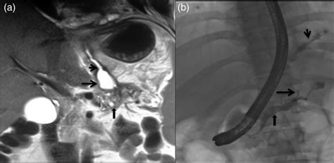 Pancreaticopleural Fistula Coronal Magnetic Resonance Mr Image A