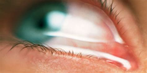 8 Penyebab Mata Berair Yang Perlu Diketahui Berikut Cara Mengatasinya