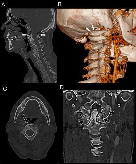 Ct Scan Of The Craniovertebral Junction Bone Reconstructions From
