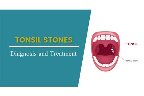 Tonsil Stones Dentalhealth