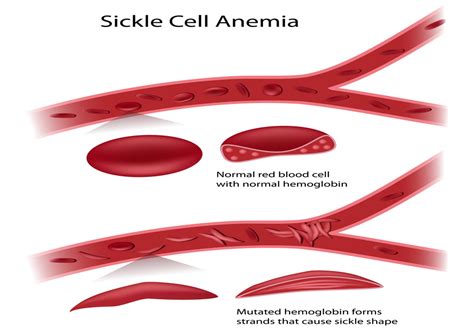 Hidden Dangers Of Sickle Cell Anemia Autoimmune Diseases Slideshows