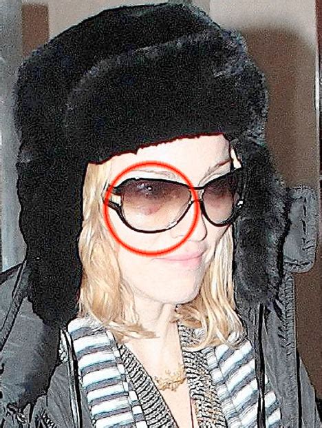 Just What Is The Truth Behind Madonnas Bruises Daily Mail Online