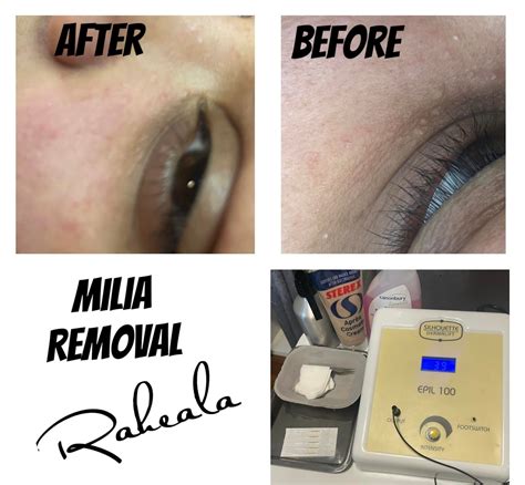 What Is Milia Milia Are Tiny Holistic Beauty Clinic