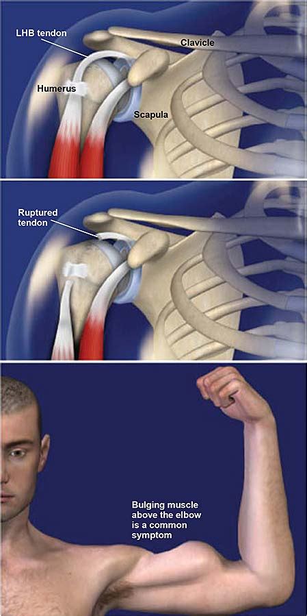 Ruptura Del Tendón Del Bíceps Grupo Médico Ortopédico De La Costa Central