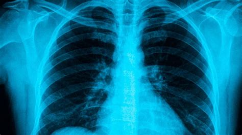 Healthy Lung Xray Wise Impressed
