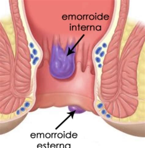Emorroidi Esterne Cause Sintomi E Cura Vivere Al Meglio Hot Sex Picture