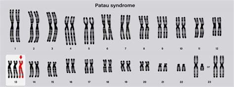 Síndrome De Patau Sintomas E Tratamentos De Doença Genética Rara