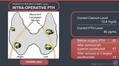 Intraoperative Parathyroid Hormone Pth Testing Dr Larian