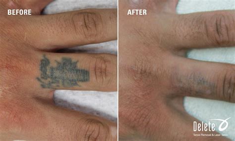 Here Is This Weeks Before And After Picoway Laser Tattoo Removal From