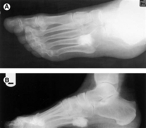 Osseous Metaplasia In Plantar Fibromatosis A Case Report The Journal