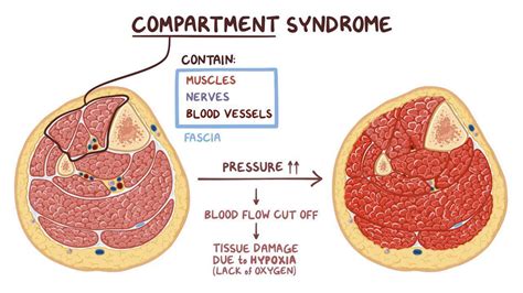 Compartment Syndrome Video Anatomy And Definition Osmosis