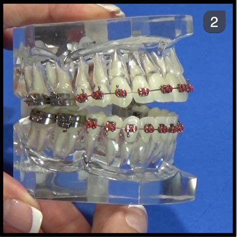 Orthodontic Demonstration Leveling And Aligning Arches With 016 X 022 Nitinol Archwires