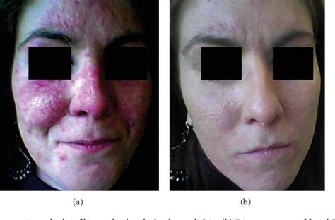 Figure 1 From A Case Of Subacute Cutaneous Lupus Erythematosus In A