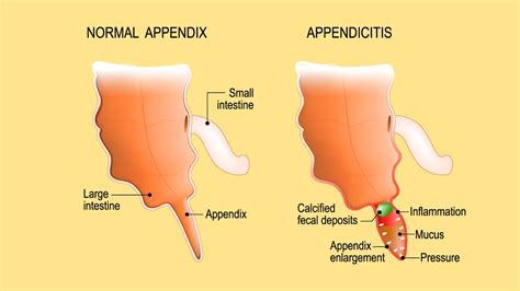 What Is An Appendix And What Does It Do Artofit