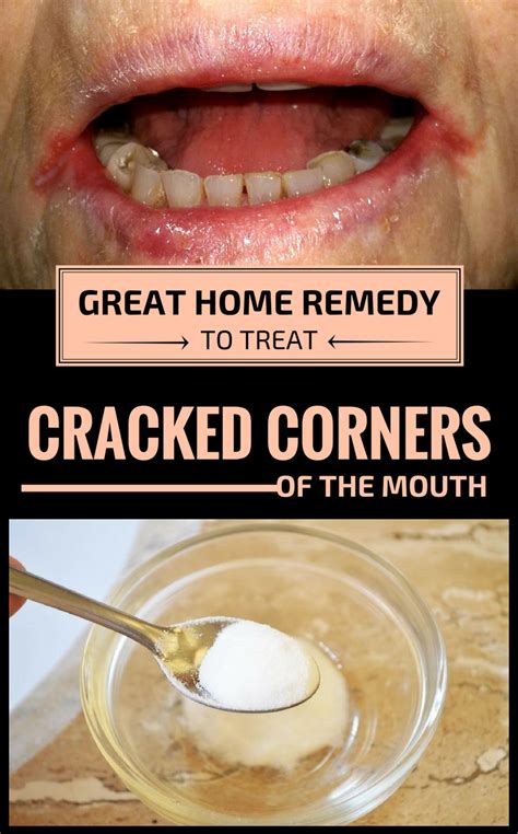 I took advise from this forum use home remedies by using apple cider mix with water to clean it. Great Home Remedy To Treat Cracked Corners Of The Mouth ...