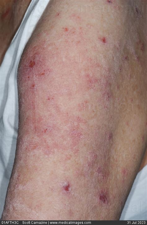 Stock Image Skin Lesions Of Dermatitis Herpetiformis Dh Also Called