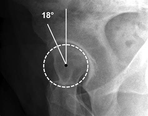 Best Practices Hip Femoroacetabular Impingement Ajr