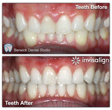 Invisalign Clear Aligners Berwick Dental Studio Dentist Berwick
