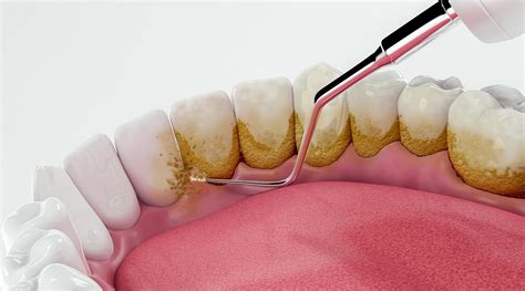 The Benefits Of A Scale And Polish Ascent Dental Care