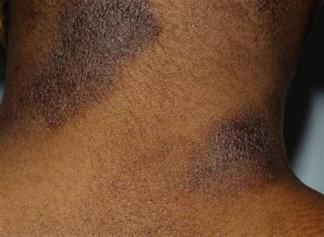 Widely Used Skin Black Spots Itchy Skinny