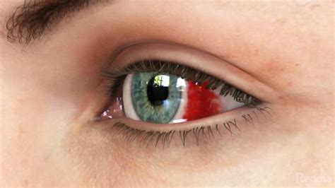 Subconjunctival Hemorrhage First Eye Care Downtown Dallas