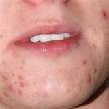 Photos of Home Remedies For Rosacea Pimples
