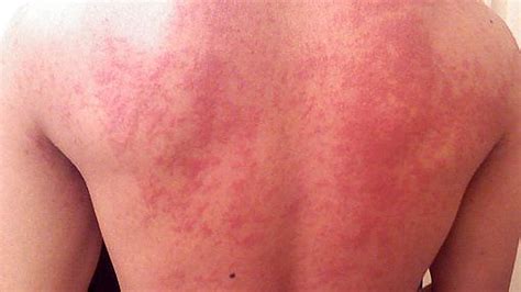 Stress Hives On Legs The Letter Of Recomendation