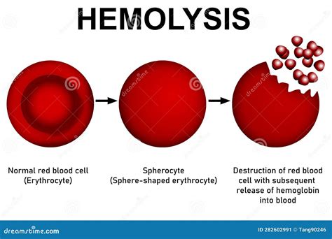 Scientific Diagram And Process Of Hemolysis Stock Illustration
