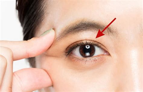 Double Eyelid Pics Surgery And Other Treatments