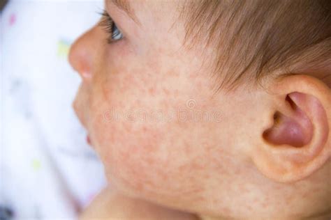 Food Allergy Skin Rash Baby