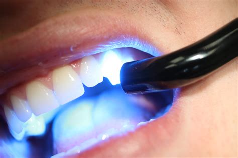 Curing The Composite Westway Dental