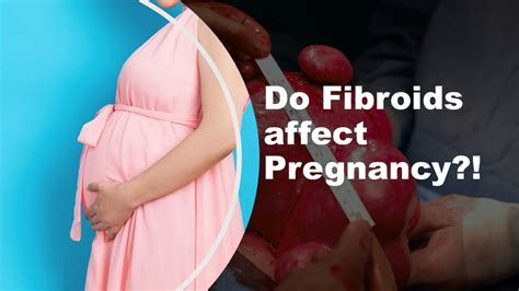 Do Uterine Fibroids Affect Pregnancy Youtube