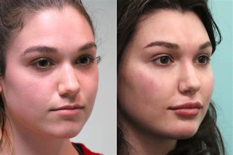 Cheeks Midface Injections Before And After Photos The Naderi Center