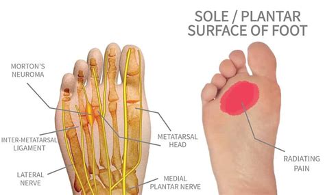 Stump Neuroma Bregman Foot Ankle And Nerve Center