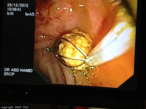Common Bile Duct Stone Removed With A Dormia Basket Sages