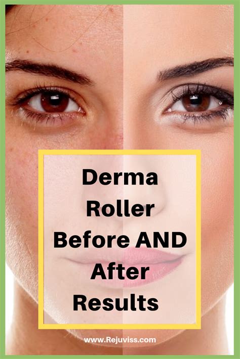 Derma Roller Before And After Results Derma Roller Derma Rolling Derma Roller Results
